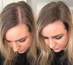 Thinning Hair Women