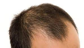 Male Pattern Baldness