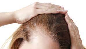 Understanding Hair Loss