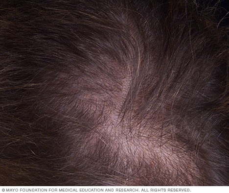 What is Female Pattern Baldness (FPHL)