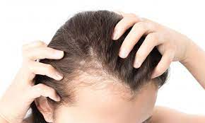 What is Female Pattern Hair Loss