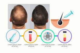 What is Platelet-Rich Plasma (PRP)