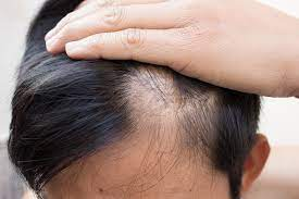 does low testosterone cause hair loss